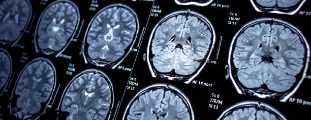 Vanavond webinar 'Palliatieve zorg bij Hersentumoren'. Interview met spreker Walter Taal